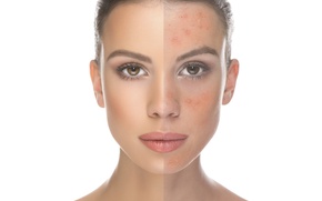Micro-Needling (DermaFrac™)