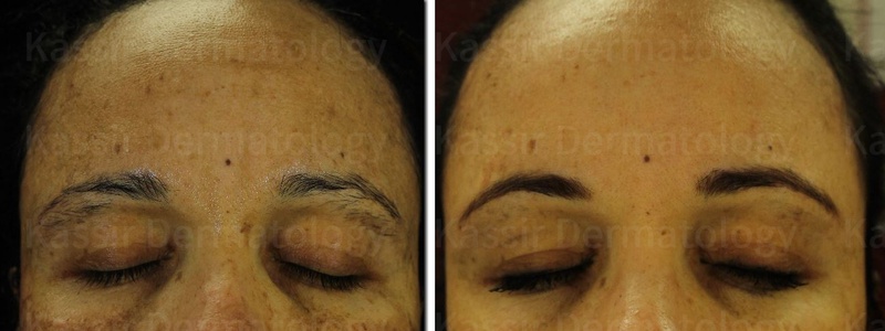 Melasma Treatment dallas image