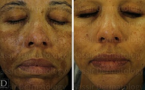 best Pigmented Lesions dallas