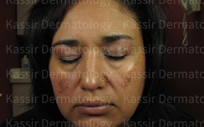 best Melasma Treatment dallas