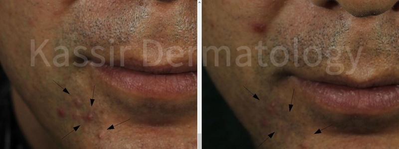 Acne Treatment dallas image