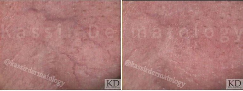 Vascular Lesions dallas image