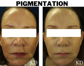 Melasma Treatment dallas