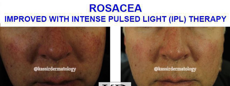 Rosacea dallas image