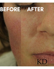 IPL Photofacial dallas