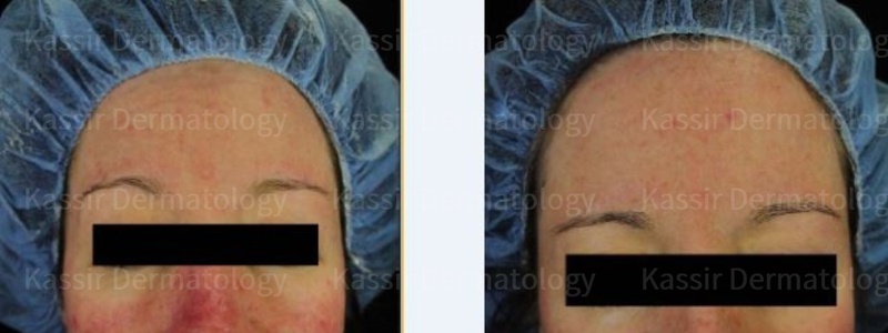 Rosacea dallas image