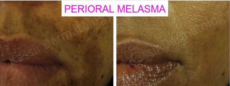 Melasma Treatment dallas image