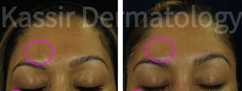 Melasma Treatment dallas image