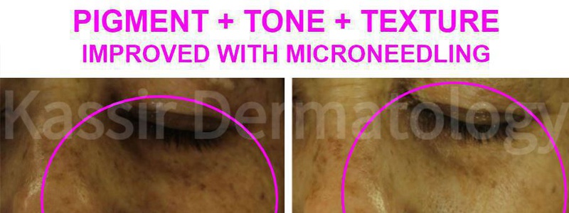 Micro-Needling dallas image