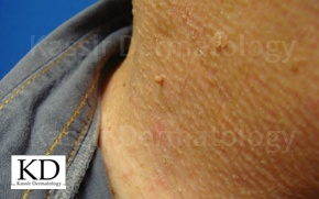 best Skin Tag Removal dallas