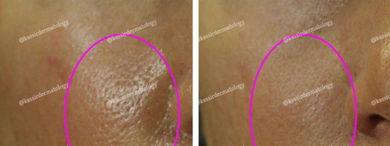 Micro-Needling dallas image