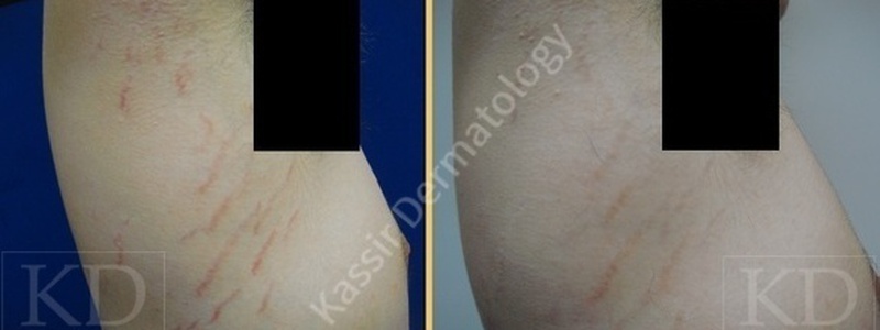 Stretch Marks Treatment dallas image