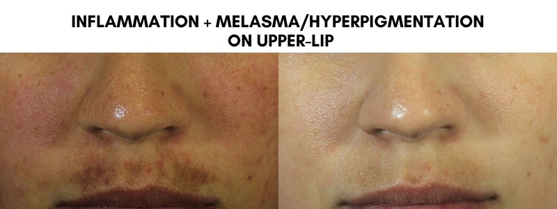 Melasma Treatment dallas image