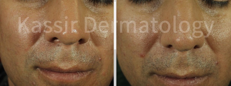 Acne Treatment dallas image