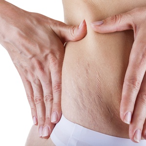 Stretch Marks Treatment dallas