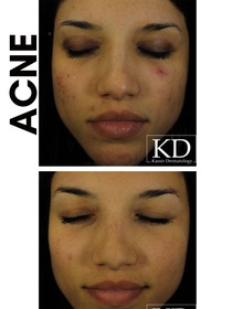 Acne Treatment dallas