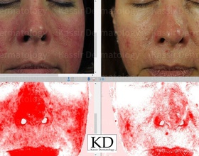 Rosacea dallas