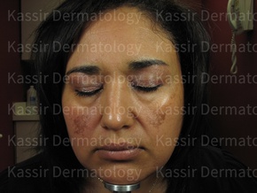 Melasma Treatment dallas