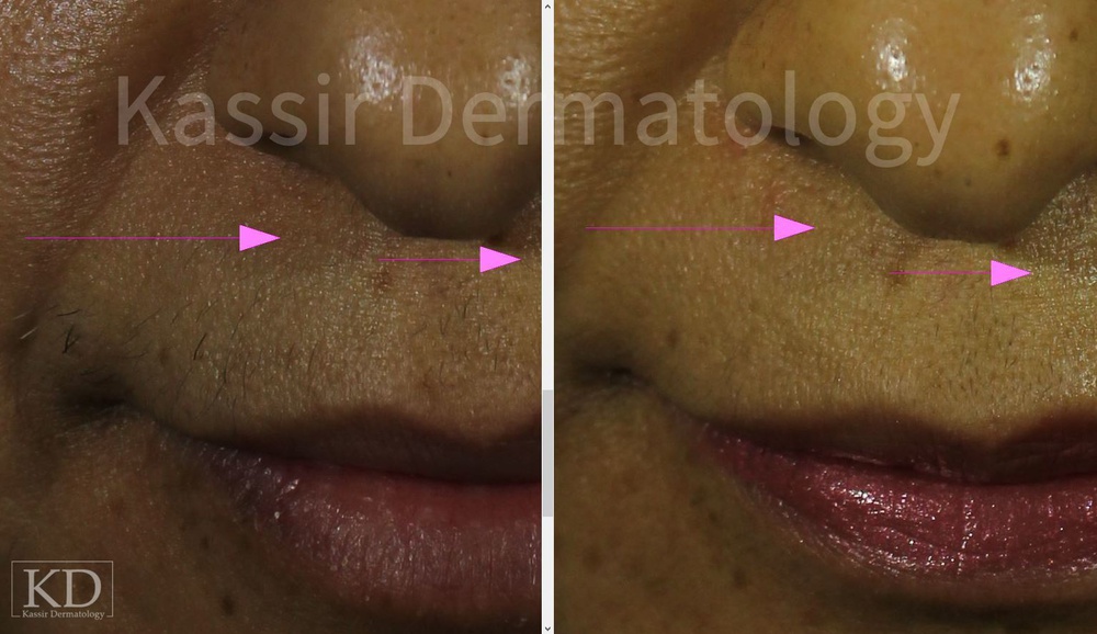 Laser Hair Removal Before & After in Dallas, Patient 10 | Kassir  Dermatology, Cosmetic Dermatologist in Dallas TX