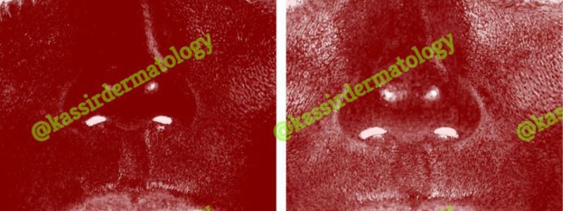 Melasma Treatment dallas image