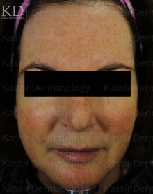 Rosacea dallas