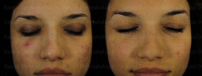 Acne Treatment dallas image