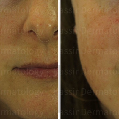 Melasma Treatment dallas