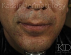Acne Treatment dallas