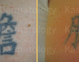 Laser Tattoo Removal dallas