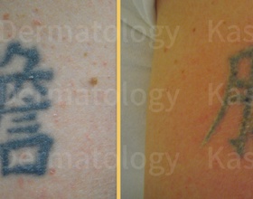 Laser Tattoo Removal Dallas | Best Laser Tattoo Removal in Dallas TX Laser Tattoo Removal Dallas | Best Laser Tattoo Removal in Dallas TX
