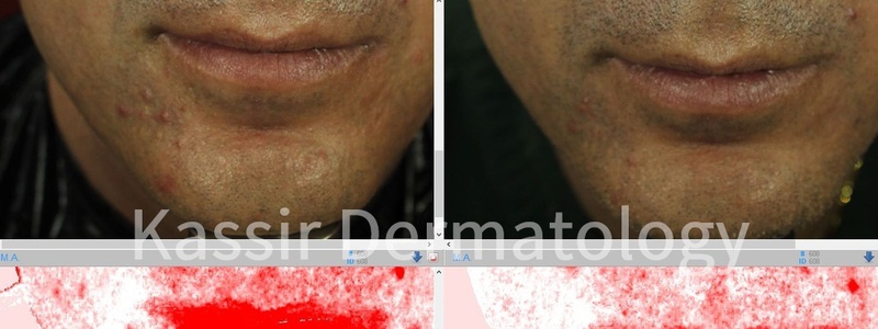 Acne Treatment dallas image