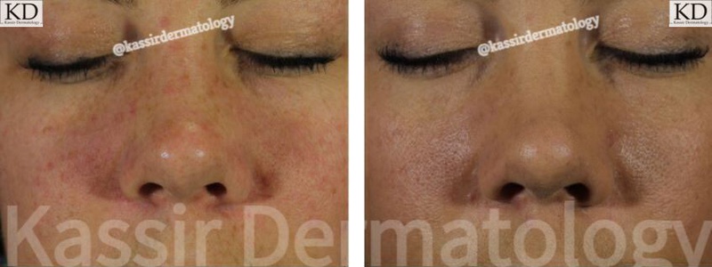 Rosacea dallas image