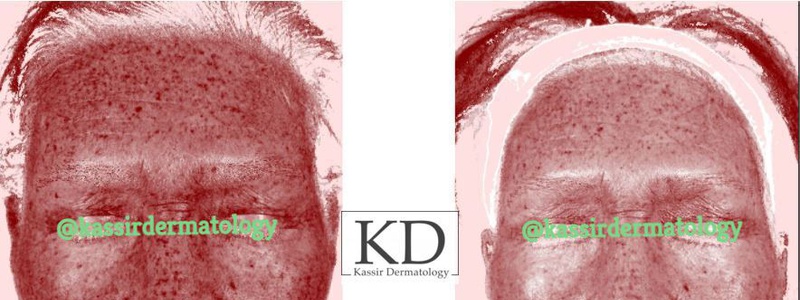 Pigmented Lesions dallas image