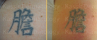 Laser Tattoo Removal dallas