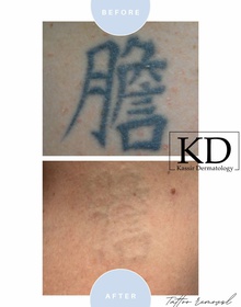 Laser Tattoo Removal dallas