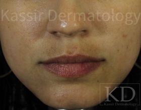 Pigmented Lesions dallas