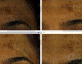 Melasma Treatment dallas