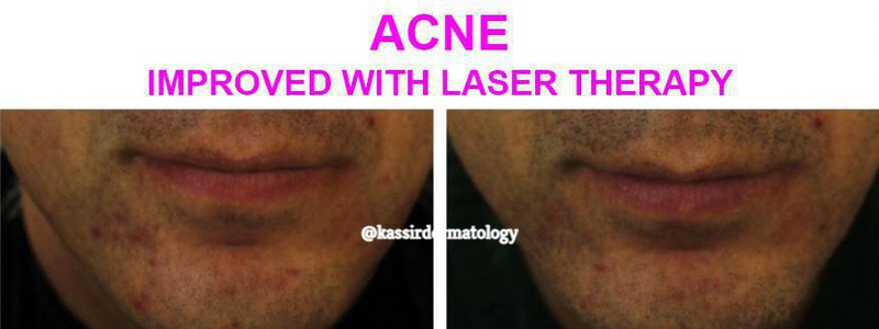 Acne Treatment dallas image