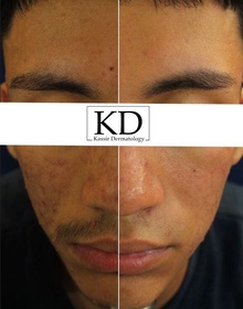 Acne Treatment dallas