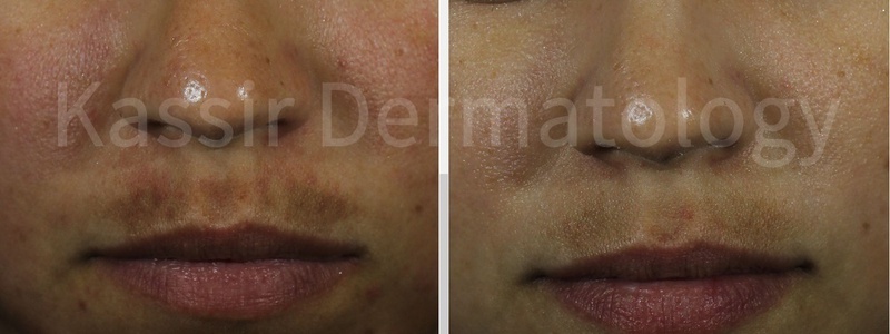 Melasma Treatment dallas image