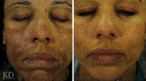 Pigmented Lesions dallas