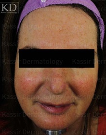 Rosacea dallas