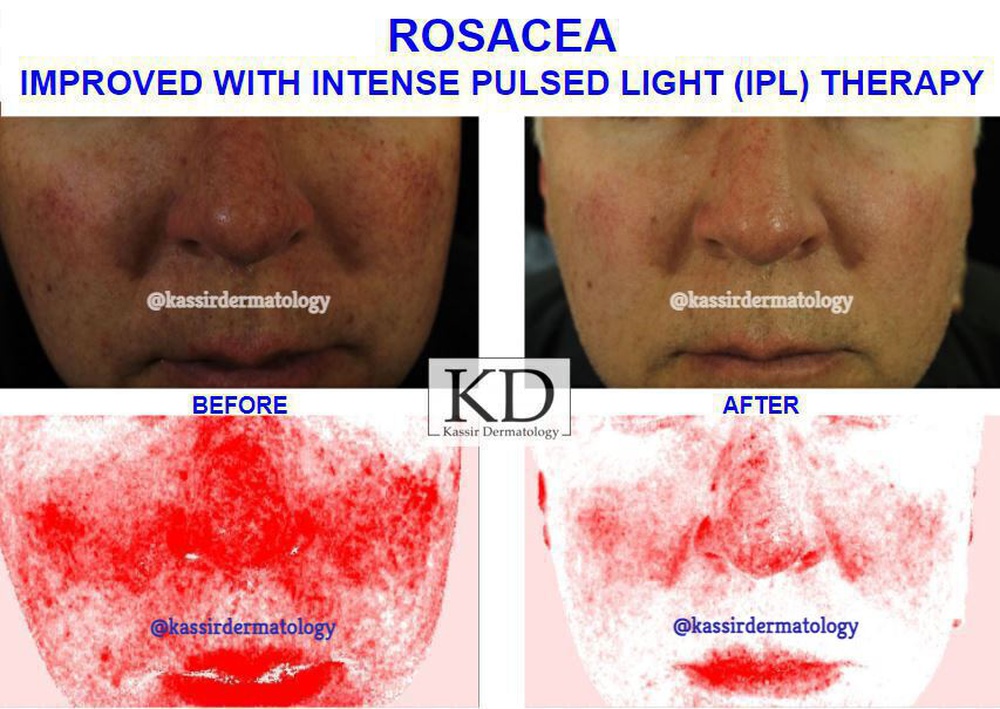 IPL Photofacial Gallery | Dermatology Gallery in | Kassir Dermatology, Cosmetic Dermatologist Dallas TX