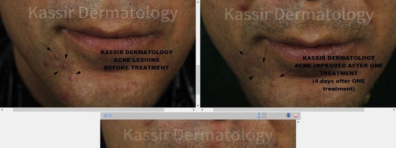 Acne Treatment dallas image