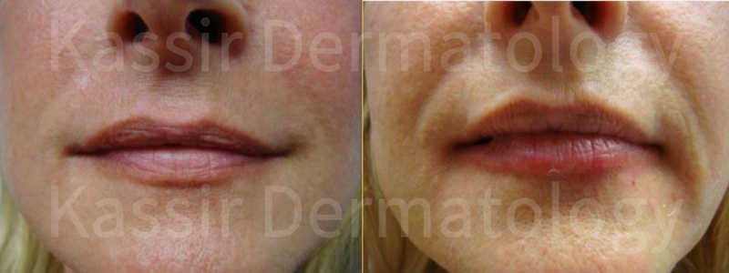 Injectable Dermal Fillers dallas image