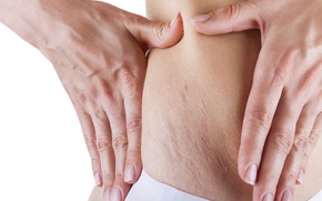 best Stretch Marks Treatment dallas