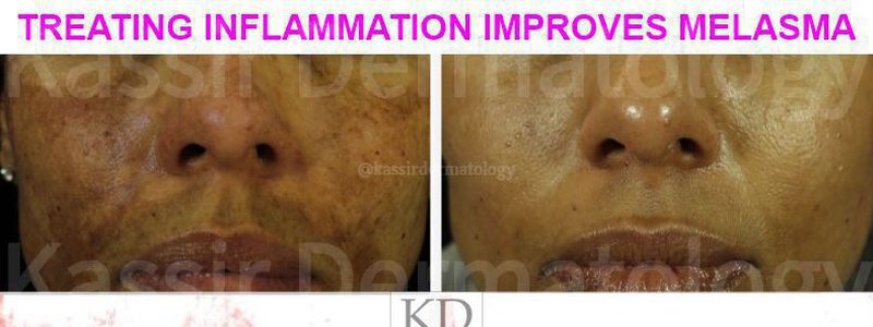 Melasma Treatment dallas image