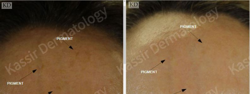 Pigmented Lesions dallas image