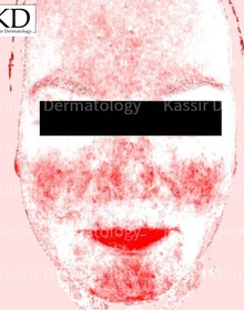 Rosacea dallas