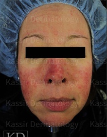 Rosacea dallas